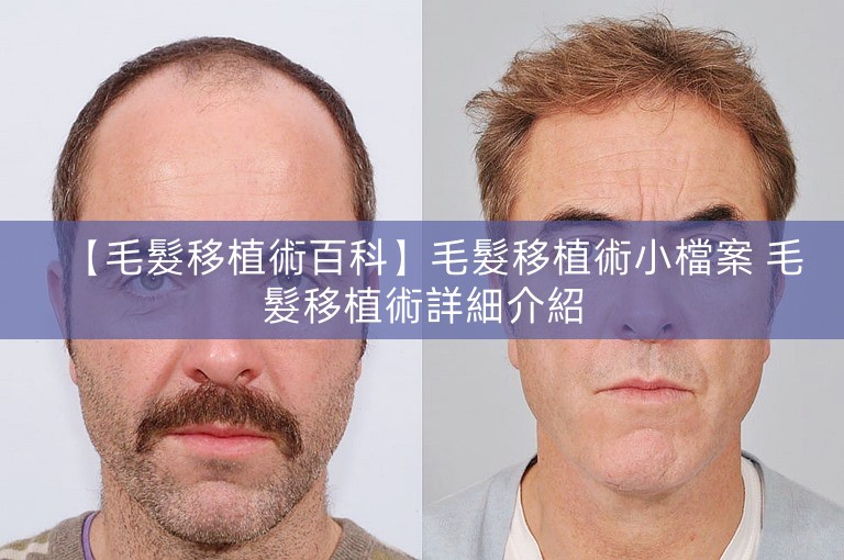【毛髮移植術百科】毛髮移植術小檔案 毛髮移植術詳細介紹