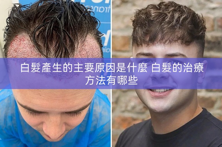 白髮產生的主要原因是什麼 白髮的治療方法有哪些