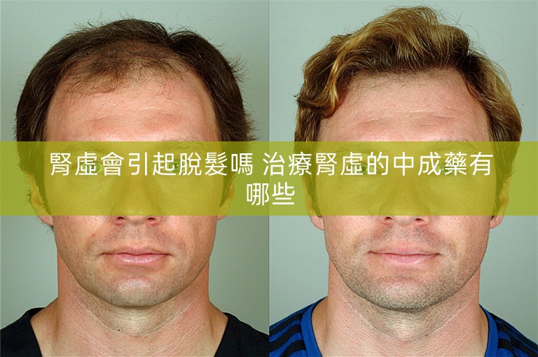 腎虛會引起脫髮嗎 治療腎虛的中成藥有哪些