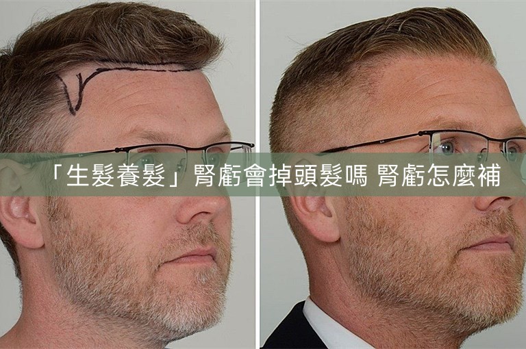 「生髮養髮」腎虧會掉頭髮嗎 腎虧怎麼補