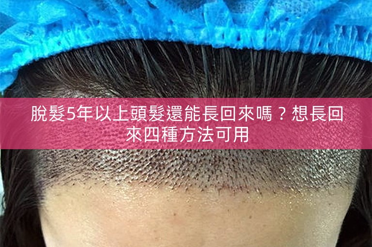 脫髮5年以上頭髮還能長回來嗎？想長回來四種方法可用