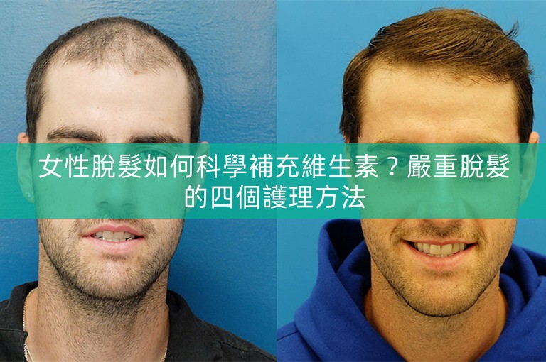 女性脫髮如何科學補充維生素？嚴重脫髮的四個護理方法