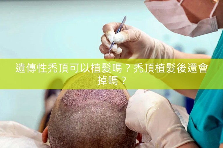 遺傳性禿頂可以植髮嗎？禿頂植髮後還會掉嗎？