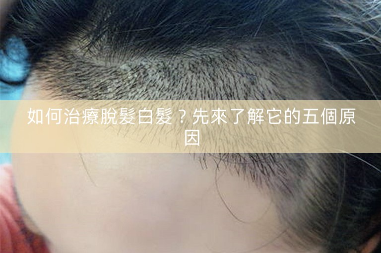 如何治療脫髮白髮？先來了解它的五個原因