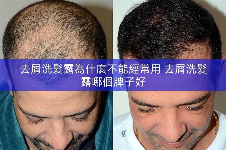 去屑洗髮露為什麼不能經常用 去屑洗髮露哪個牌子好
