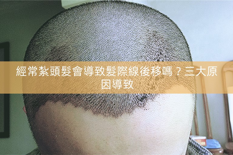 經常紮頭髮會導致髮際線後移嗎?三大原因導致 經常紮頭髮會導致髮際線後移嗎?三大原因導致