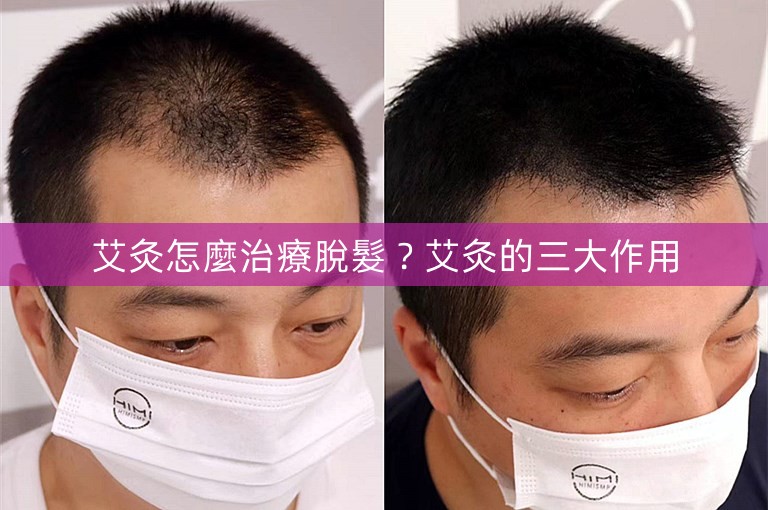 艾灸怎麼治療脫髮？艾灸的三大作用