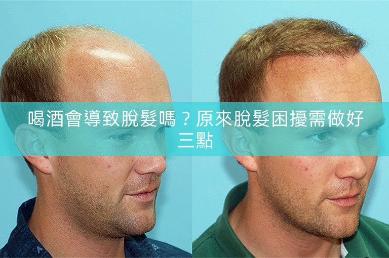 喝酒會導致脫髮嗎？原來脫髮困擾需做好三點