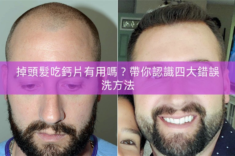 掉頭髮吃鈣片有用嗎？帶你認識四大錯誤洗方法