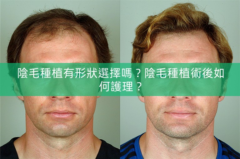 陰毛種植有形狀選擇嗎？陰毛種植術後如何護理？