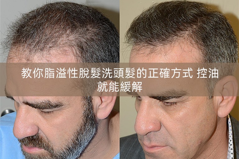 教你脂溢性脫髮洗頭髮的正確方式 控油就能緩解