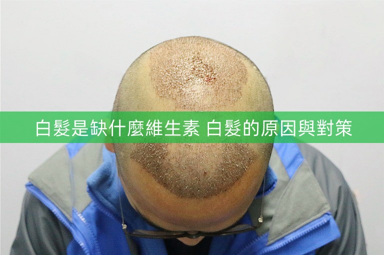 白髮是缺什麼維生素 白髮的原因與對策