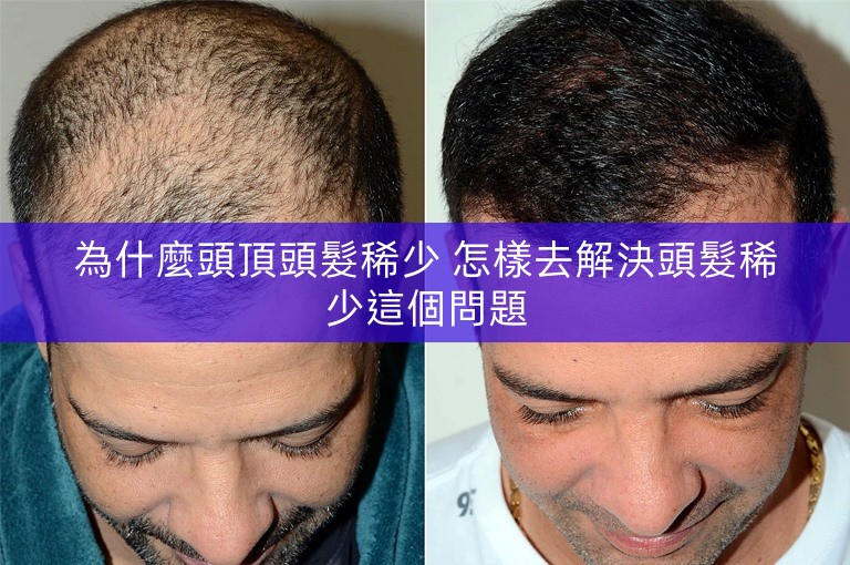 為什麼頭頂頭髮稀少 怎樣去解決頭髮稀少這個問題
