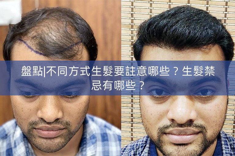 盤點|不同方式生髮要註意哪些？生髮禁忌有哪些？