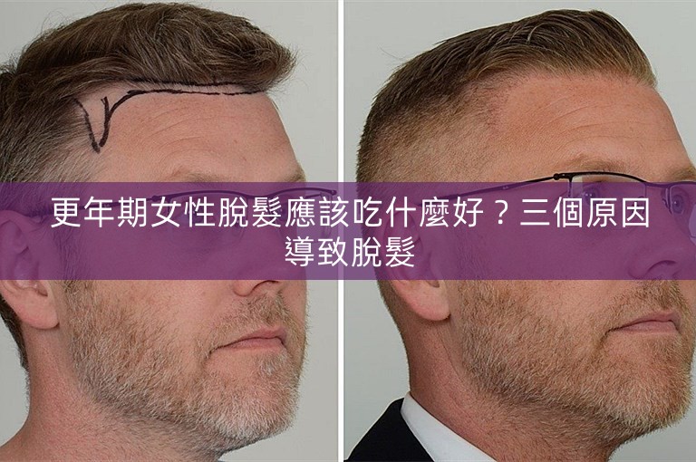 更年期女性脫髮應該吃什麼好？三個原因導致脫髮