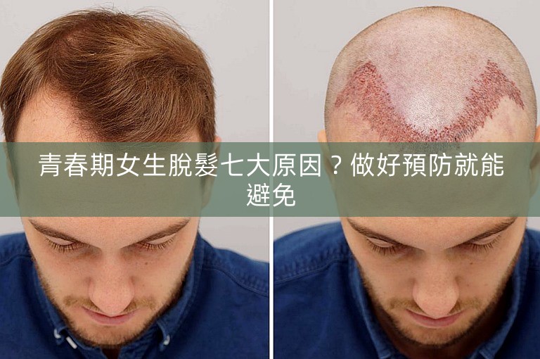 青春期女生脫髮七大原因？做好預防就能避免