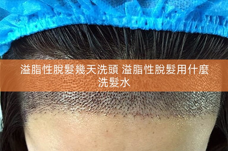 溢脂性脫髮幾天洗頭 溢脂性脫髮用什麼洗髮水