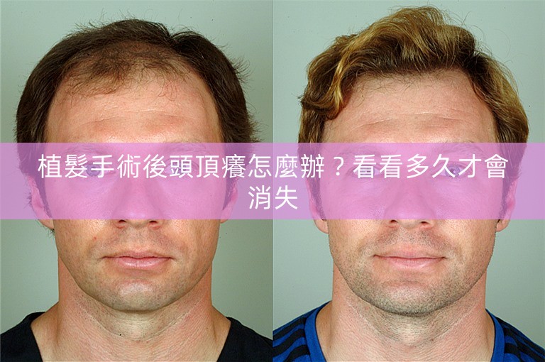 植髮手術後頭頂癢怎麼辦？看看多久才會消失