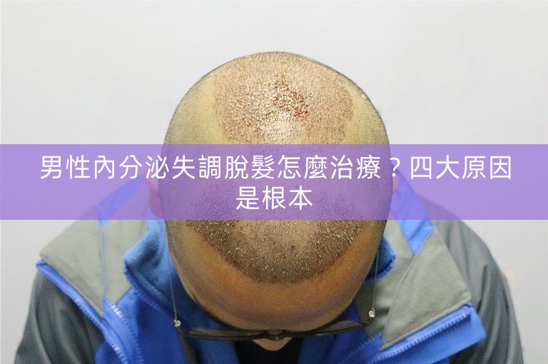 男性內分泌失調脫髮怎麼治療？四大原因是根本