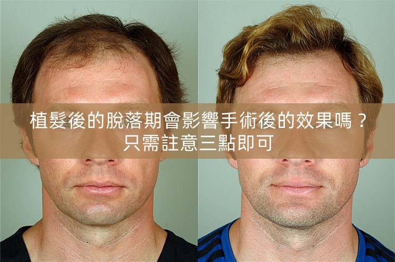 植髮後的脫落期會影響手術後的效果嗎？只需註意三點即可
