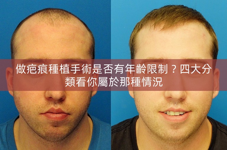 做疤痕種植手術是否有年齡限制？四大分類看你屬於那種情況
