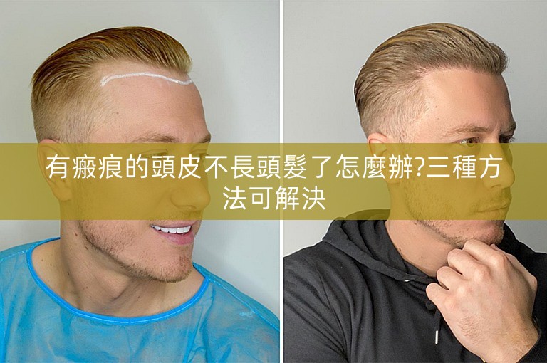 有瘢痕的頭皮不長頭髮了怎麼辦?三種方法可解決 有瘢痕的頭皮不長頭髮了怎麼辦?三種方法可解決