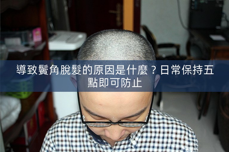 導致鬢角脫髮的原因是什麼?日常保持五點即可防止 導致鬢角脫髮的原因是什麼?日常保持五點即可防止