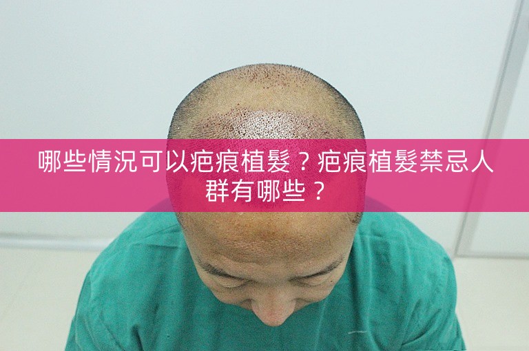 哪些情況可以疤痕植髮?疤痕植髮禁忌人群有哪些? 哪些情況可以疤痕植髮?疤痕植髮禁忌人群有哪些?