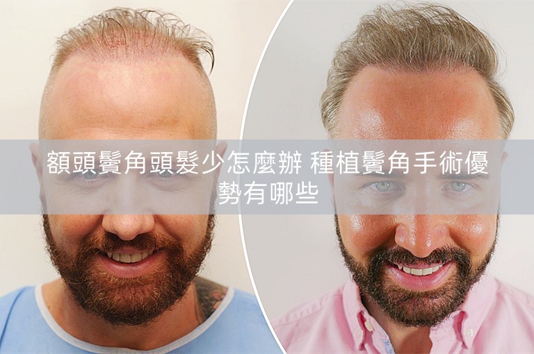 額頭鬢角頭髮少怎麼辦 種植鬢角手術優勢有哪些