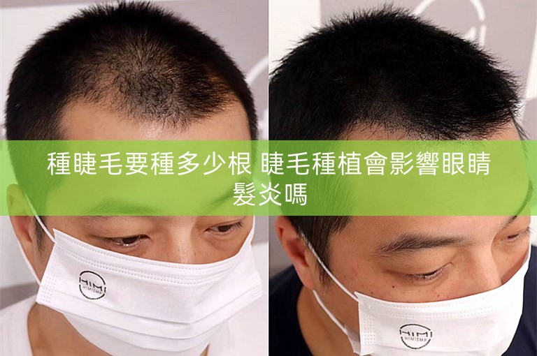 種睫毛要種多少根 睫毛種植會影響眼睛髮炎嗎