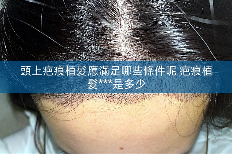 頭上疤痕植髮應滿足哪些條件呢 疤痕植髮***是多少