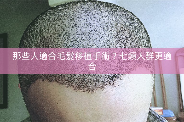 那些人適合毛髮移植手術？七類人群更適合