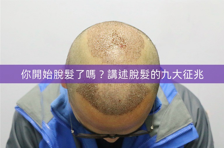 你開始脫髮了嗎？講述脫髮的九大征兆
