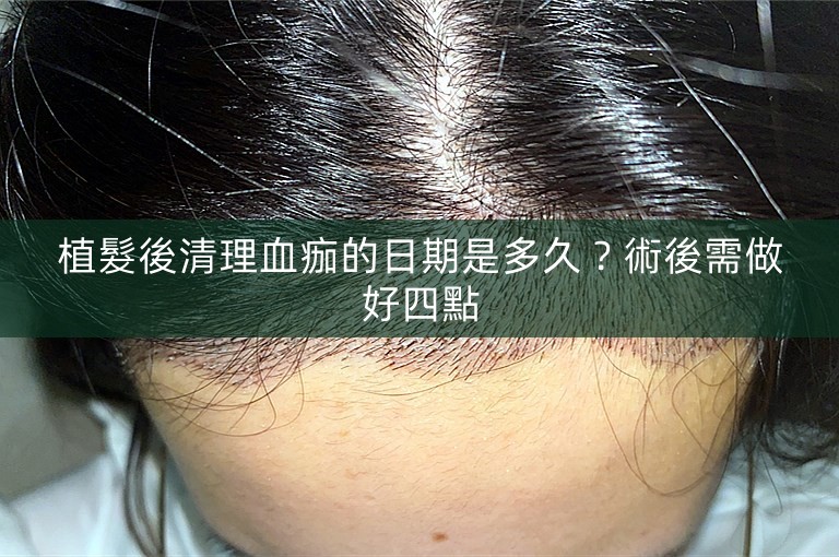 植髮後清理血痂的日期是多久?術後需做好四點 植髮後清理血痂的日期是多久?術後需做好四點