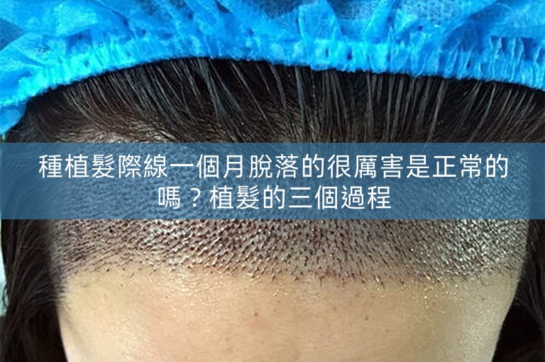 種植髮際線一個月脫落的很厲害是正常的嗎？植髮的三個過程