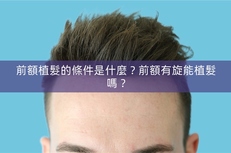 前額植髮的條件是什麼?前額有旋能植髮嗎? 前額植髮的條件是什麼?前額有旋能植髮嗎?