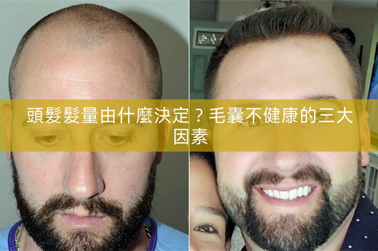 頭髮髮量由什麼決定？毛囊不健康的三大因素