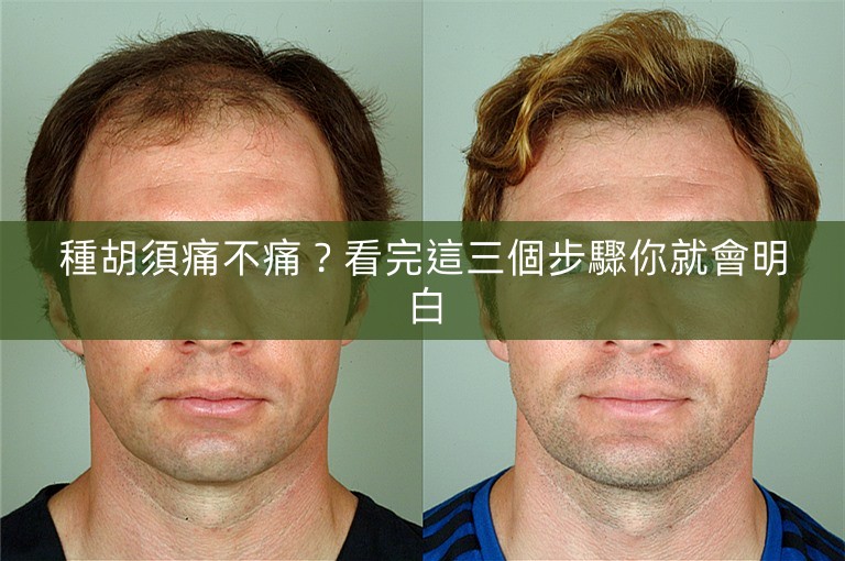 種胡須痛不痛?看完這三個步驟你就會明白 種胡須痛不痛?看完這三個步驟你就會明白