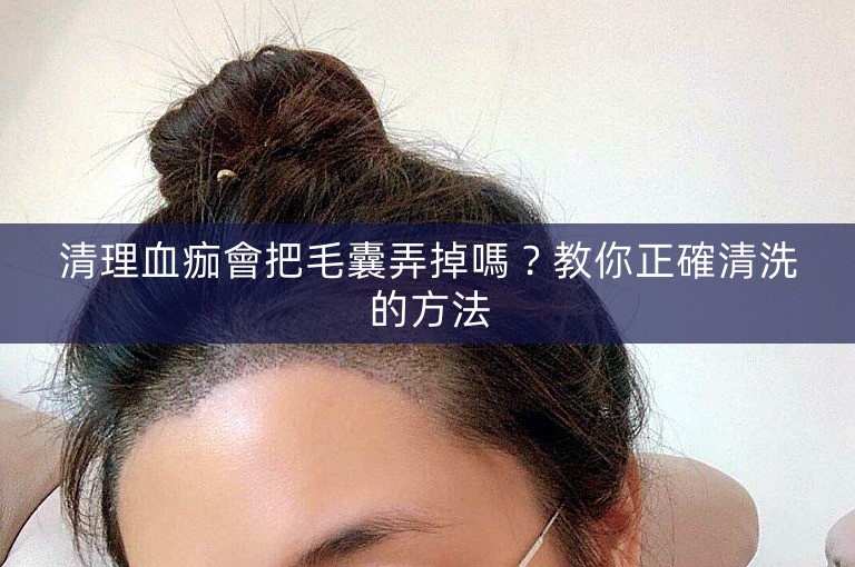 清理血痂會把毛囊弄掉嗎？教你正確清洗的方法