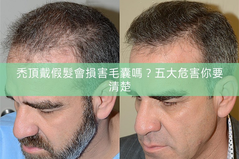 禿頂戴假髮會損害毛囊嗎？五大危害你要清楚