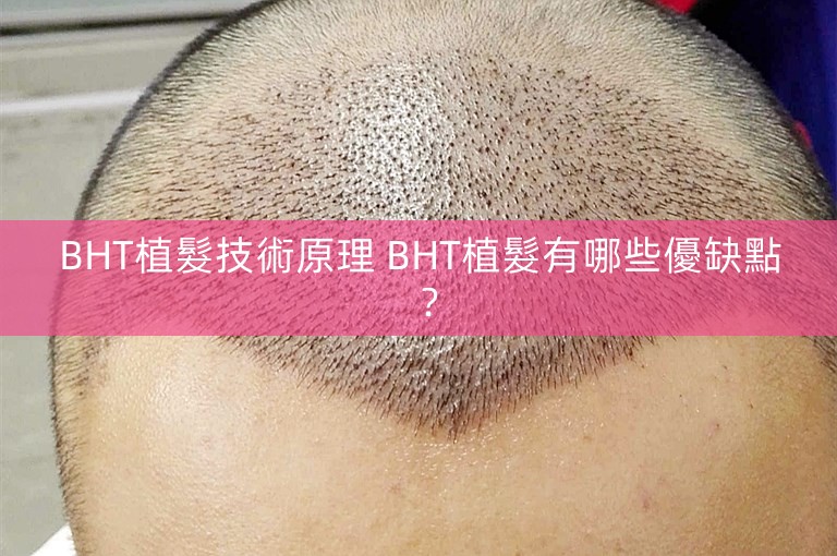 BHT植髮技術原理 BHT植髮有哪些優缺點？