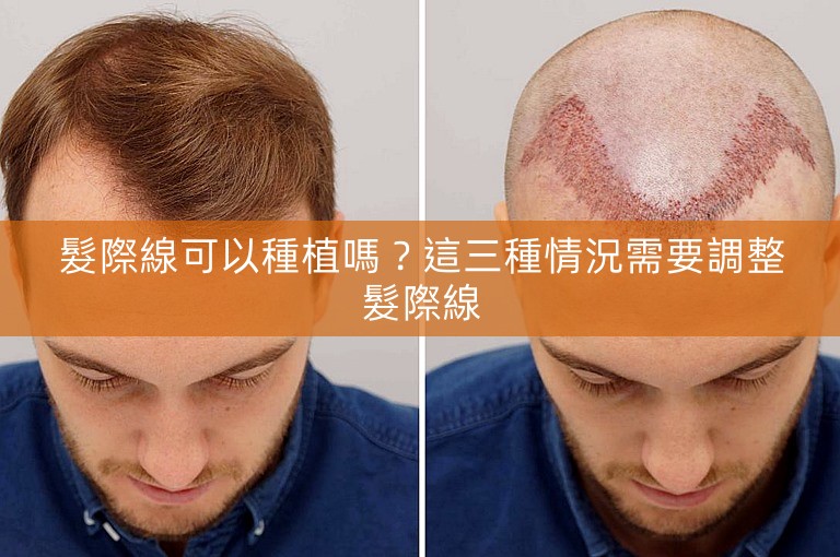 髮際線可以種植嗎？這三種情況需要調整髮際線