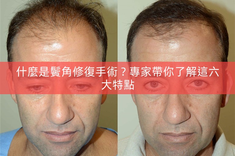 什麼是鬢角修復手術？專家帶你了解這六大特點