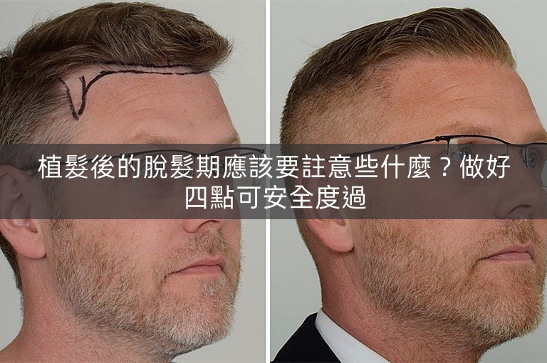 植髮後的脫髮期應該要註意些什麼？做好四點可安全度過