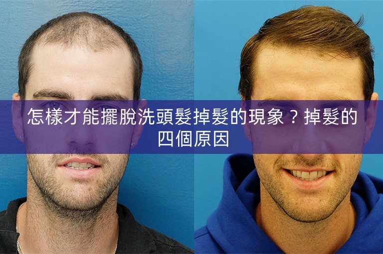 怎樣才能擺脫洗頭髮掉髮的現象？掉髮的四個原因