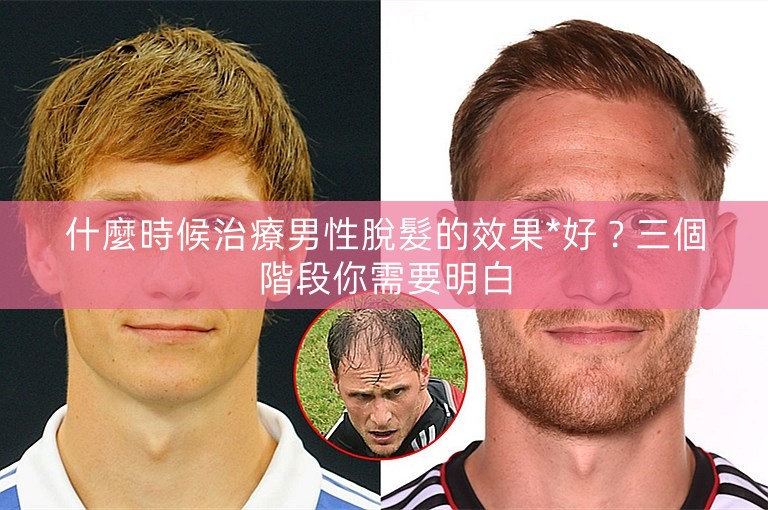 什麼時候治療男性脫髮的效果*好？三個階段你需要明白