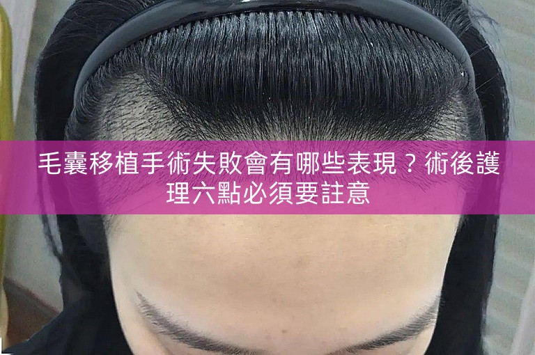 毛囊移植手術失敗會有哪些表現?術後護理六點必須要註意 毛囊移植手術失敗會有哪些表現?術後護理六點必須要註意
