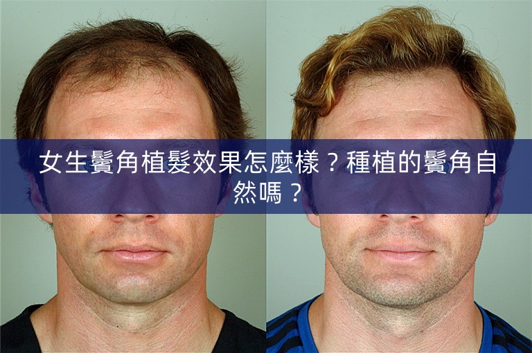 女生鬢角植髮效果怎麼樣？種植的鬢角自然嗎？