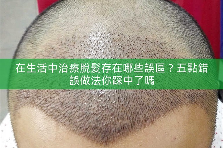 在生活中治療脫髮存在哪些誤區？五點錯誤做法你踩中了嗎