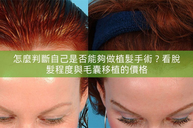 怎麼判斷自己是否能夠做植髮手術？看脫髮程度與毛囊移植的價格